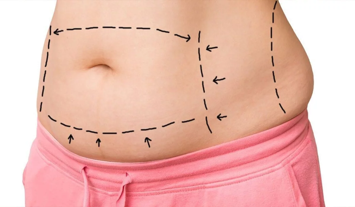 Liposuction