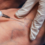 sclerotherapy treatment in Sydney