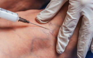 sclerotherapy treatment in Sydney