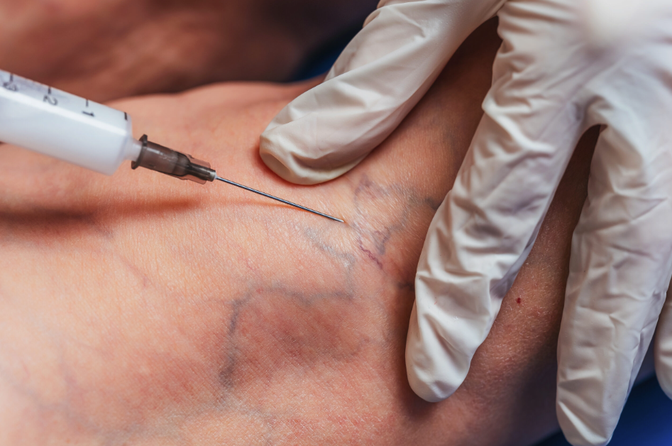 sclerotherapy treatment in Sydney